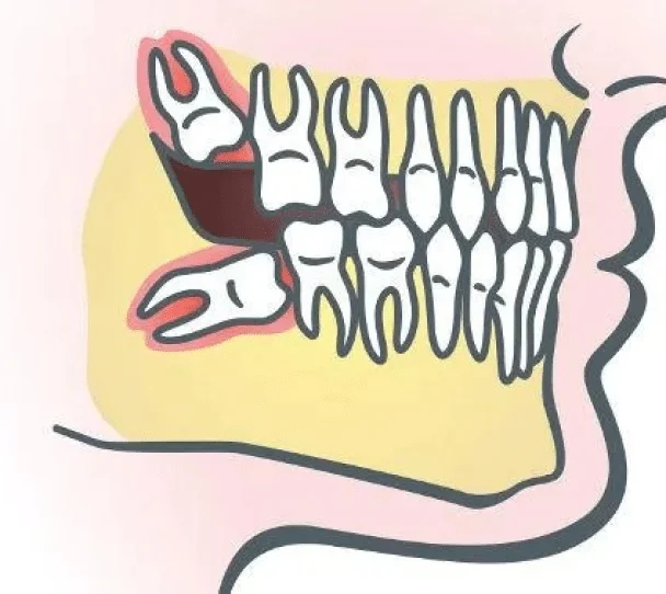 Wisdom Tooth Removal