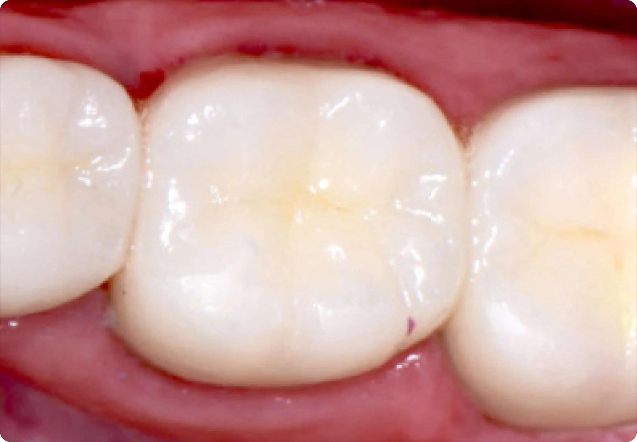 Tooth Colored Fillings