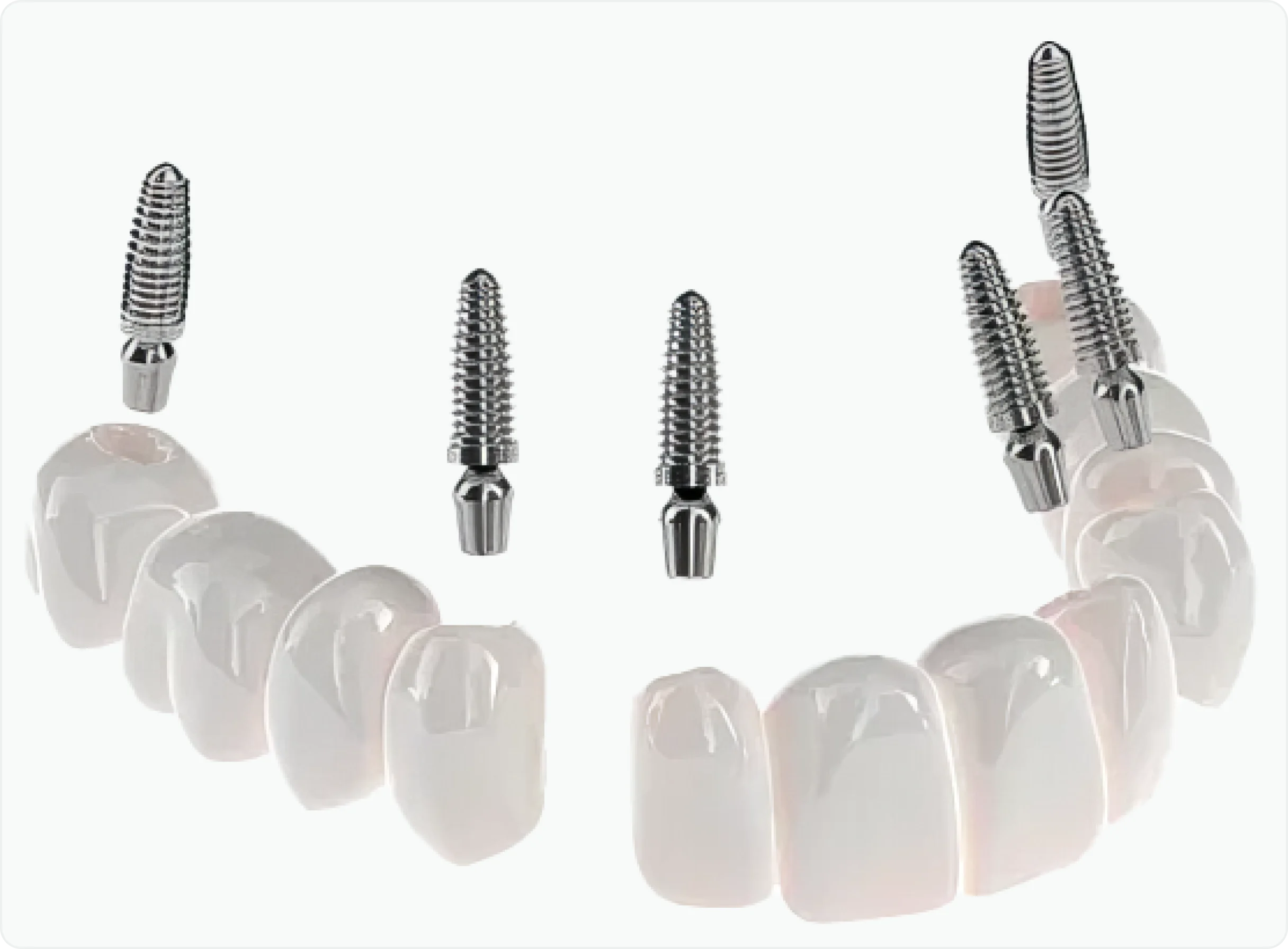 Dental Implants and Your Health | Delaney Park Dental