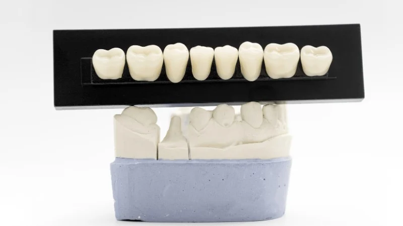 veneers for teeth grinding