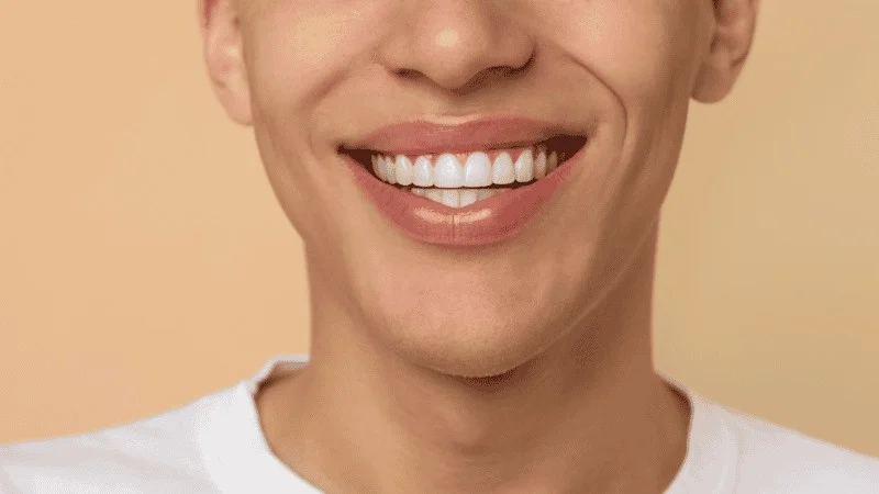 how many veneers do i need